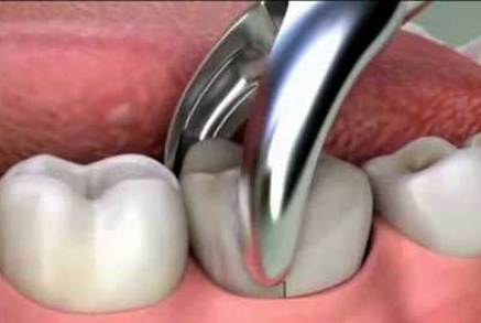 Да се вади ли зъб с убит нерв при неуспешно лечение?